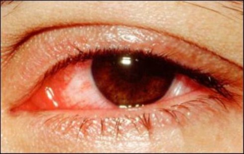 Đau mắt đỏ hay còn gọi là bệnh viêm kết mạc là bệnh gặp phổ biến, xảy ra ở mọi lứa tuổi và thường gia tăng khi thời tiết chuyển mùa. Triệu chứng ban đầu của bệnh là nóng rát mắt, đau, có cảm giác cộm mắt, nhìn mờ, mi mắt sưng nề, chảy nước mắt.