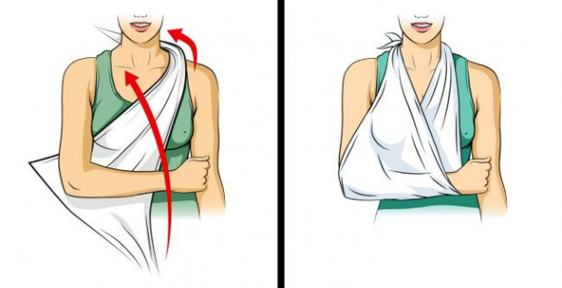 Gãy tay: Cánh tay bị gãy nên được giữ cố định bằng cách sử dụng một chiếc khăn hoặc áo để đeo nó trên cổ. Ráng giữ cố định cánh tay như thế để nó không bị thương nặng hơn và để người khác không vô tình va chạm phải.