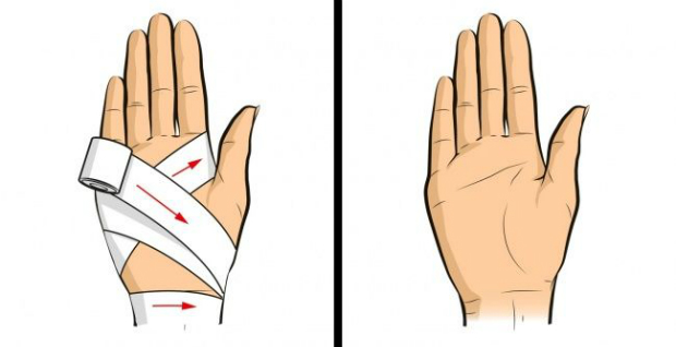 Chấn thương bàn tay: Cách quấn băng như thế này sẽ giúp cố định các khớp và xương trong bàn tay.
