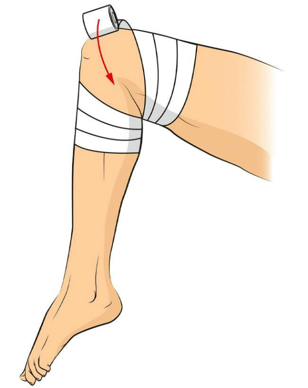 Chấn thương đầu gối: Cách quấn băng này sẽ giúp cố định khớp gối, và cần giữ gối ở tư thế này trong khi được đưa đến bệnh viện.