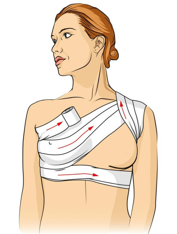 Chấn thương ngực hoặc xương đòn:Nên áp dụng kiểu quấn băng này trong trường hợp có người bị chấn thương ở vùng ức và ngực.