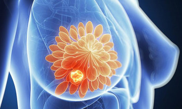 Trí tuệ nhân tạo dự báo ung thư vú trước một năm