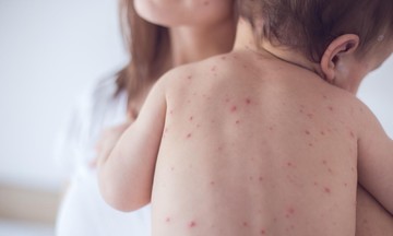 5 bệnh dễ để lại sẹo trên da có thể phòng ngừa nhờ vaccine